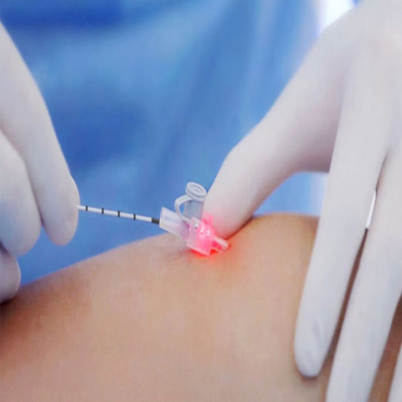 Varicose Veins Treatment