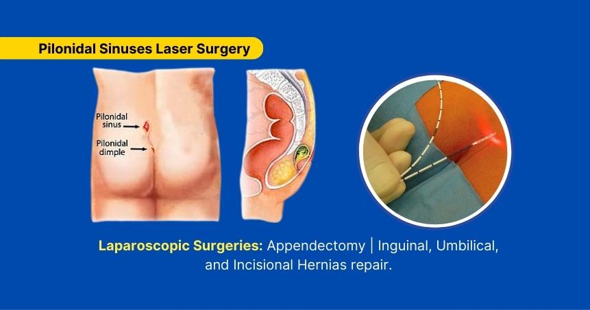 Pilonidal Sinuses Laser Surgery