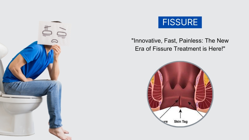 Best fissure treatment in Hyderabad